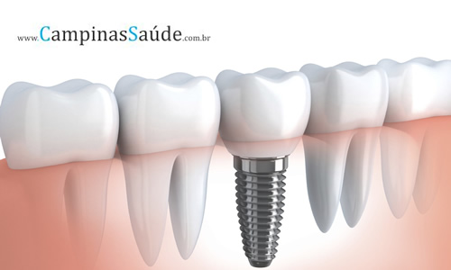 QUAL O CUSTO DE UM IMPLANTE DENTÁRIO ? QUAL O CUSTO DE UM IMPLANTE DENTÁRIO ?