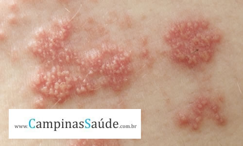 Como se adquiri a Herpes? Como se adquiri a Herpes?