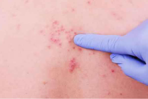 Herpes-zóster: O que é? E como previnir ou tratar? Herpes-zóster: O que é? E como previnir ou tratar?