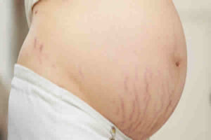 Porque na gestação pode surgir estrias na barriga?
